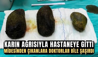 Karın ağrısı şikayetiyle hastaneye başvuran kadının midesinden 2 kilo saç çıktı