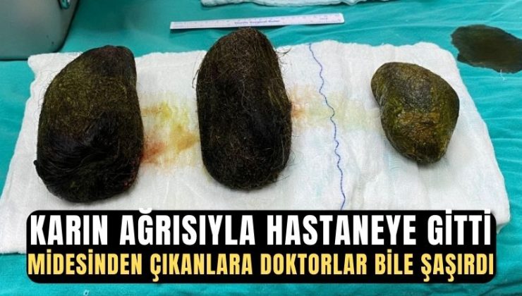 Karın ağrısı şikayetiyle hastaneye başvuran kadının midesinden 2 kilo saç çıktı